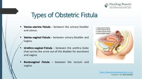 Obstetric Fistula Causes Symptoms And Treatment