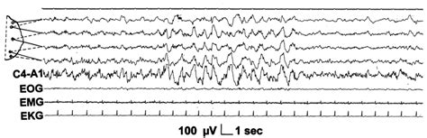 Delta Burst In Slow Wave Sleep Top 4 Channels Bioplolar Parasagittal