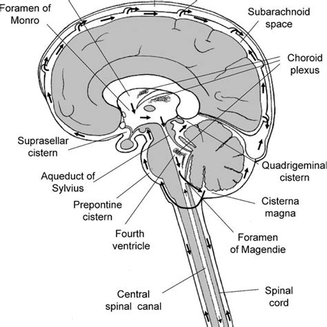 Schematic Representation Of Marked Hydrocephalus With An Enormously Download Scientific Diagram