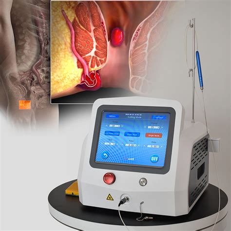 1470nm Surgical Laser Hemorrhoids Anal Fistula Proctology Laser Device