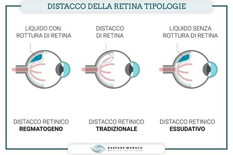 Retinopatia Da Distacco Retinico Autosomico Dominante