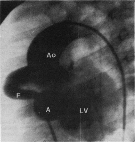 Supravalvar Aortogram In Left Anterior Oblique Projection Showing The Download Scientific