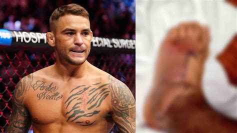 Wut Da Helllll Dustin Poirier Shares A Horrifying Photo Of His Staph