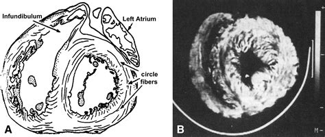 Structure And Function Relationships Of The Helical Ventricular Myocardial Band The Journal Of