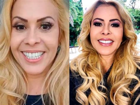 5 Famosos Que Fizeram Harmonização Facial Coderm