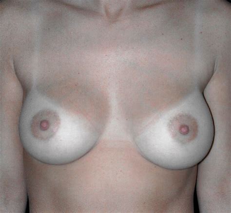 Breast Augmentation Danyo Plastic Surgery