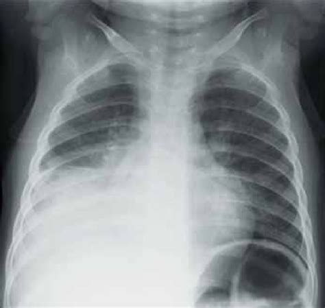 Chest X Ray Showing Opacification Of Right Lung And Pleural Effusion