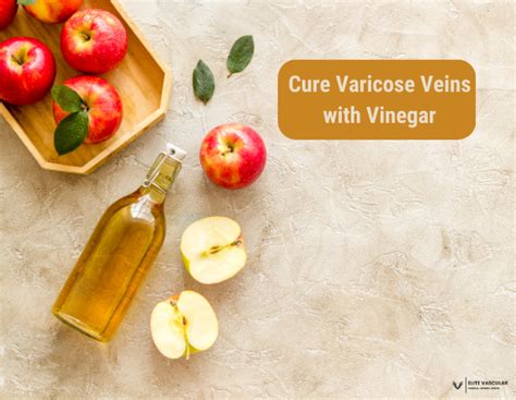 Read How To Cure Varicose Veins With Vinegar