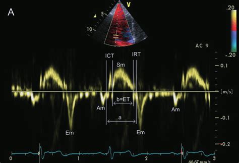 Calculation Of Tissue Doppler Derived Myocardial Performance Index