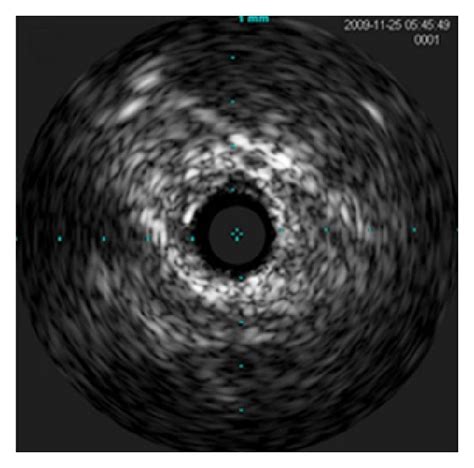 Representative Images Of Intravascular Ultrasound Ivus Over The