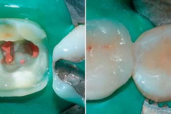 Ricostruzione Post Endodontica A Ricopertura Cuspidale Totale Diretta