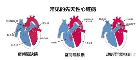 先天性心脏病严重吗能不能治好 知乎