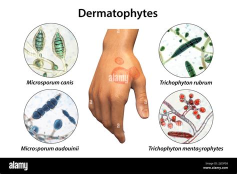 Microsporum audouinii Cut Out Stock Images & Pictures - Alamy