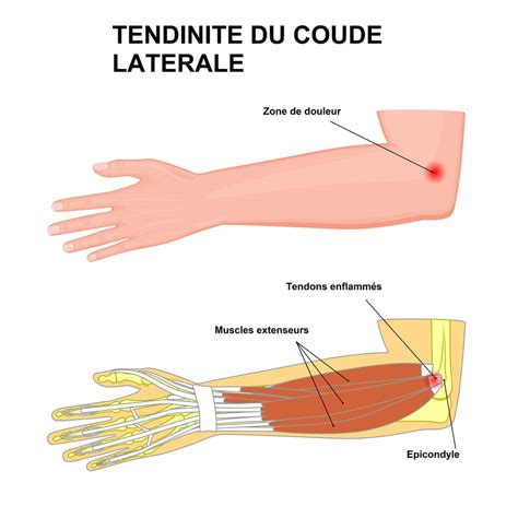 Tendinitis Of The Elbow Epicondylitis How To Treat It