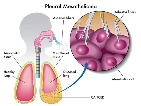 Occupations With High Risk Of Asbestos Exposure Rcm Asbestos