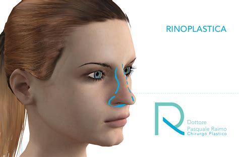 Rinoplastica Correzione Inestetismi Del Naso Dottore Pasquale Raimo