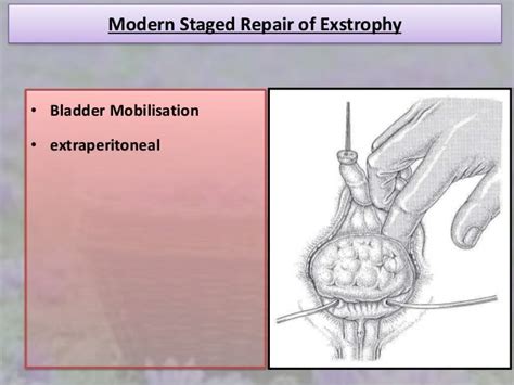 Exstrophy Epispadias Complex Msre And Cpre