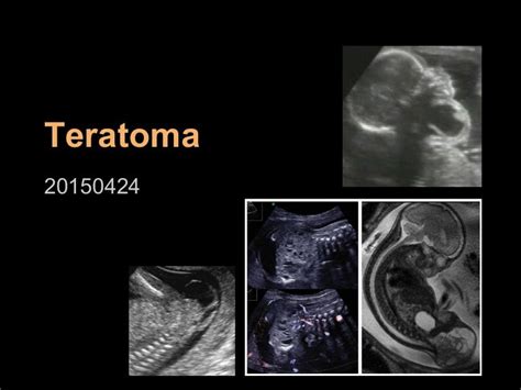 Teratoma