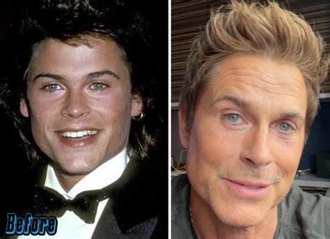 Has Rob Lowe Had Plastic Surgery