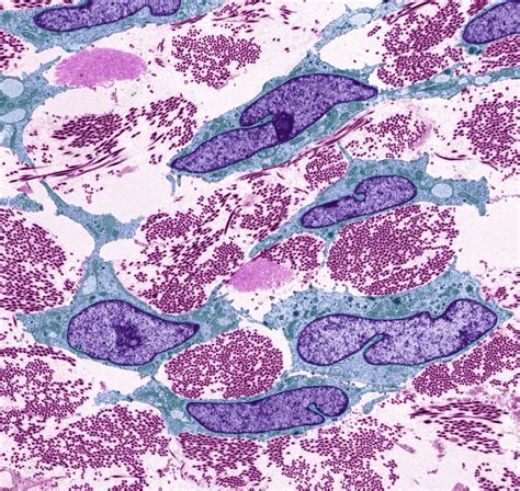 Ovarian Fibroma Tem Stock Image C0497909 Science Photo Library