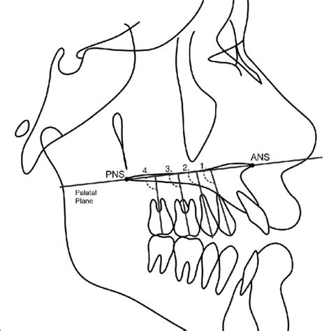 Posterior Teeth Angulations Measurements In The Maxillary Arch Related