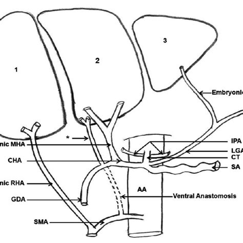 Depicting High origin of gastroduodenal artery (GDA) and relation of ...