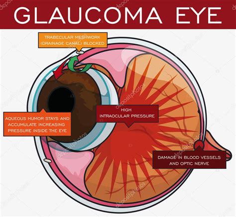 Información Sobre El Glaucoma Y Su Evolución En El Ojo Ilustración