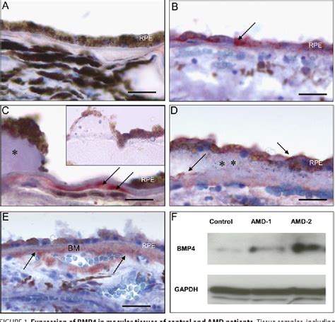 Figure From Bmp Mediates Oxidative Stress Induced Retinal Pigment