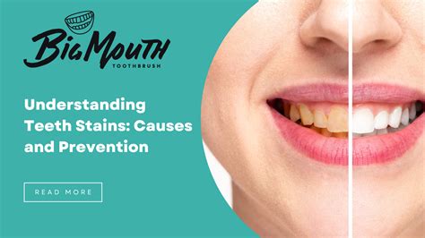 Understanding Teeth Stains: Causes and Prevention – BigMouthToothBrush