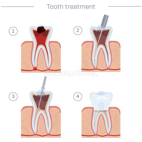 Tooth Treatment, Step by Step Instructions. Hemisection, Root Removal ...