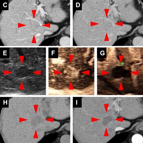 Abdominal Contrast Enhanced Computed Tomography CECT A D And