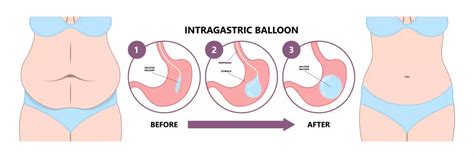 Gastric Balloon Weight Loss Surgery Booking Surgery