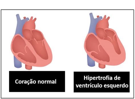 Hipertrofia De Ventr Culo Esquerdo O Que Causa