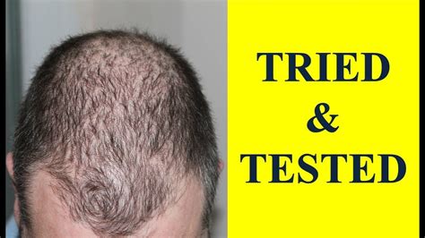 A Cure For Hair Loss Natural Remedy That Works Tried And Tested Youtube