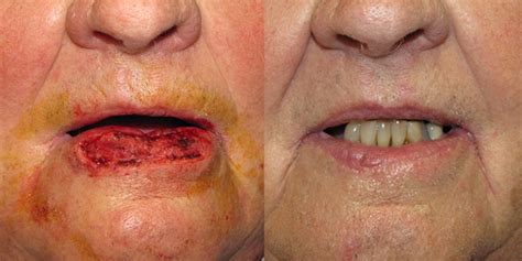 Lip Reconstruction Gallery Skin Cancer And Reconstructive Surgery Center