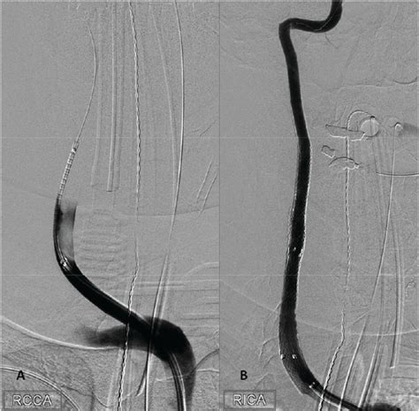 E 047 Endovascular Management Of Long Segment Carotid And Vertebral