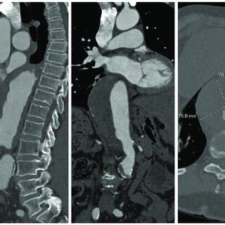 Preoperative Computed Tomography Angiogram Showing The Patient S Extent