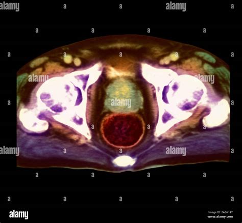 Prostate Cancer Coloured Magnetic Resonance Imaging Mri Scan Of An Axial Horizontal Section