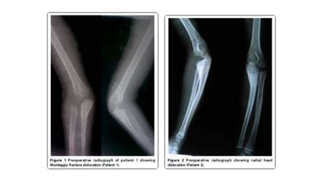 Pediatric Radial Head Dislocation Ppt