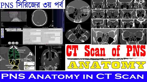 Video No 25 ANATOMY Of CT PNS PNS Anatomy In CT Scan Image CT Scan