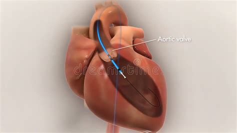 Heart Stent Insertion Process Stock Illustration - Illustration of ...