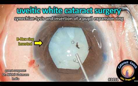 1151 White Cataract And Uveitis Synechiae Cataract Coach