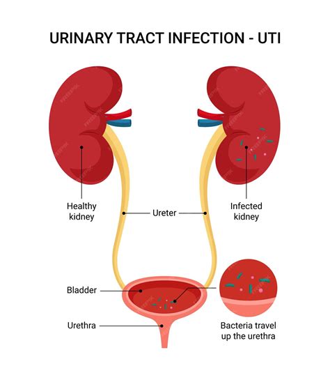 Síntomas De Una Infección Del Tracto Urinario Vector Premium