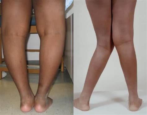 How To Deal With Bow K Leg Syndrome Medical Expert Daily Post