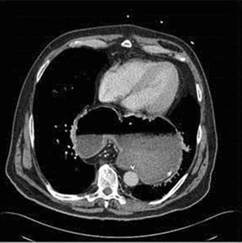 A Representative Ct Scan From One Of The Patients With A Complete