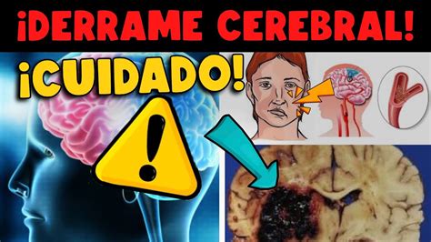 CUIDADO DERRAME CEREBRAL SINTOMAS Y PREVENCIÓN YouTube