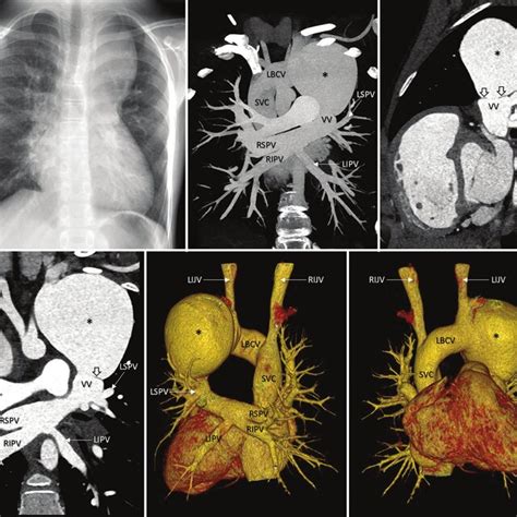 A Frontal Chest Radiograph B Maximum Intensity Projection Images