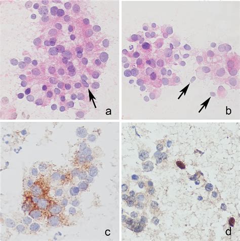 Thyroid Paraganglioma Naked Nuclei As A Clue To Diagnosis On Imprint