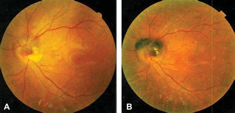 Optic Disk Melanocytoma And Optical Coherence Tomography Angiography Oct A Eyewiki