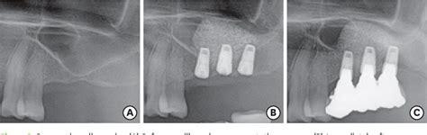 Figure 2 From Maxillary Sinus Augmentation Using Biphasic Calcium